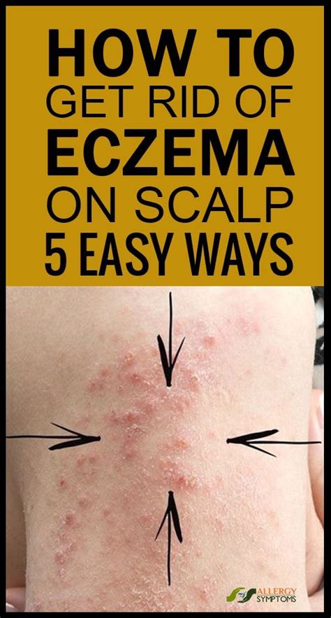 How To Get Rid Of Eczema On The Scalp Get Rid Of Eczema Allergy