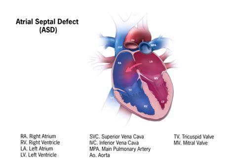Atrial Septal Defect In Children London Paediatric Cardiologist