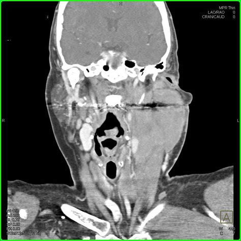 Lymphoma With Massive Neck Adenopathy Neuro Case Studies Ctisus Ct