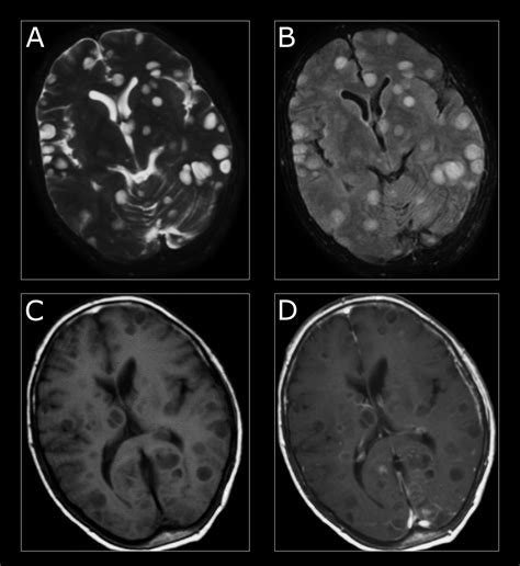 Multiple Cystic Metastases In The Brain From Adenocarcinoma Of The Lung