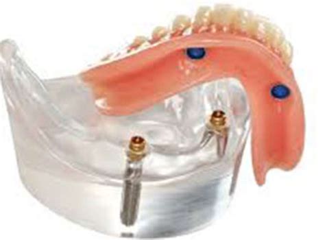 Dental Implant Supported Dentures