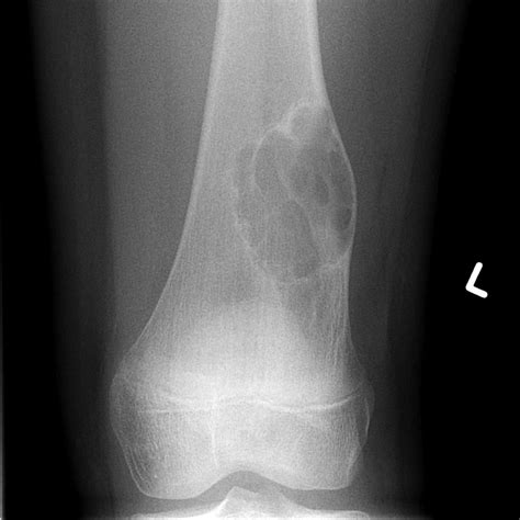Non Ossifying Fibroma Distal Femur Radiology Case
