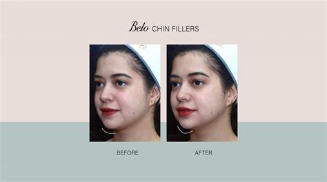 Benefits Of Getting Fillers In Your S Belo Medical Group