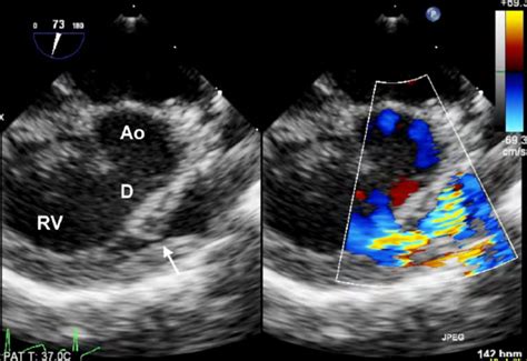 Tetralogy Of Fallot The Right Ventricle Rv Inflow Outflow View Shows