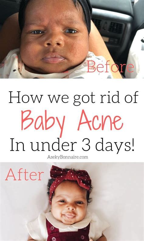 How To Get Rid Of Baby Acne Aseky Co Baby Acne Baby Acne Remedy