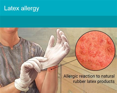 Allergic To Latex Gloves What Can I Use Images Gloves And