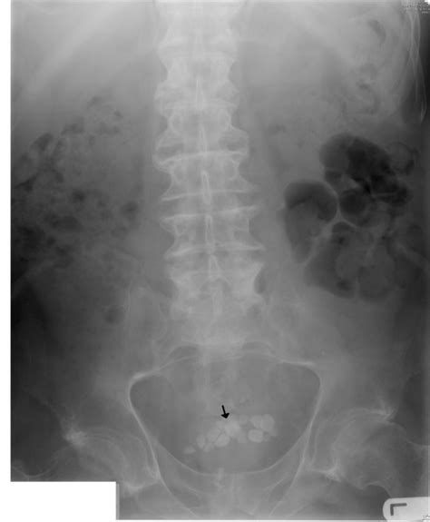X Ray Of Abdomen 27 October 2006 Reveals Several Calcified Stones In