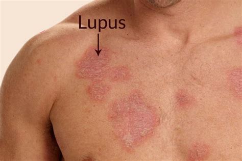 Systemic Lupus Erythematosus Sle Star Clinics