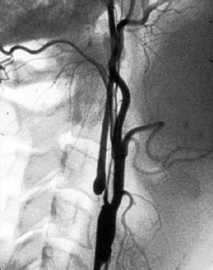 Carotid Artery Disease Clinical Features And Management Surgery