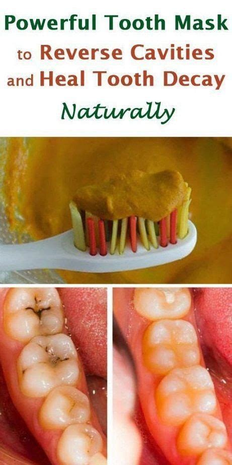 Powerful Tooth Mask To Reverse Cavities And Heal Tooth Decay Naturally