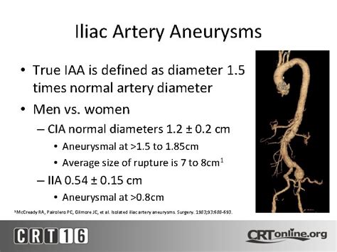 Iliac Artery Aneurysms What And How To Treat