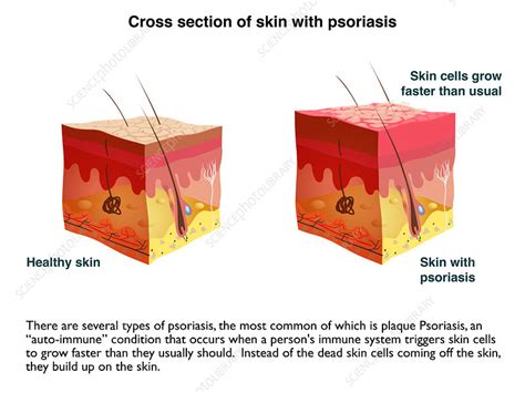 Psoriasis And Eczema Infographic Stock Image C0437504 Science