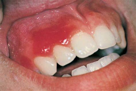 Red Lesions Of The Oral Mucosa Differential Diagnosis Clinical