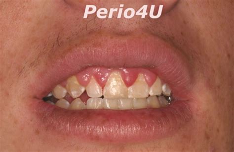Gingival Hyperplasia With Braces