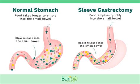 Dumping Syndrome After Gastric Sleeve Symptoms Causes And Cures