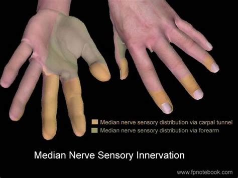 Median Nerve Palsy