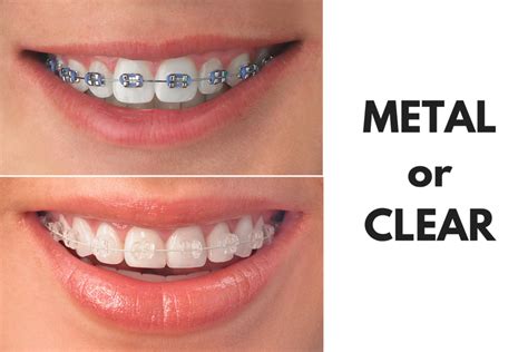 Ask Your Smyrna Dentist Whats The Difference Between Invisalign And Metal Braces Creekview