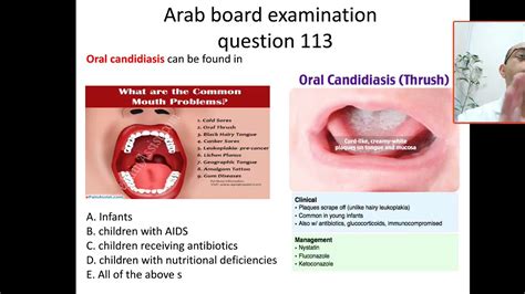 Mcq 113 What Are The Differences Between Oral Thrush And Hairy