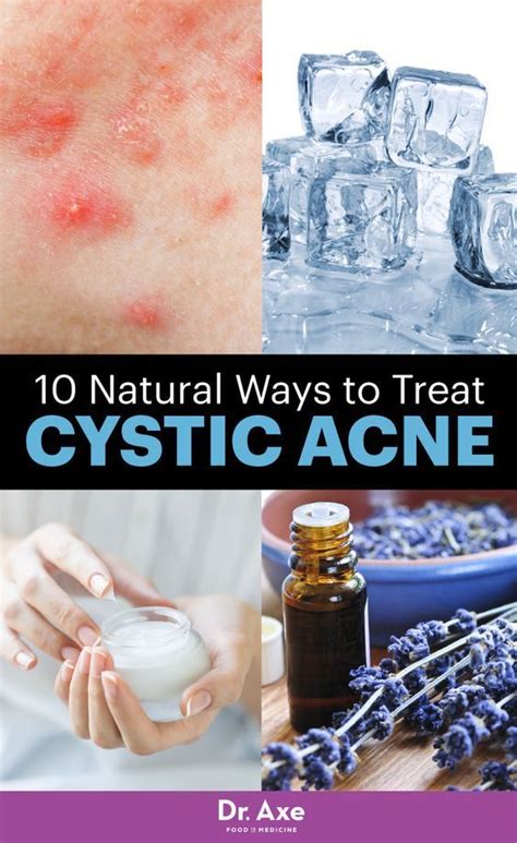 10 Natural Cystic Acne Treatments That Really Work In 2020 Cystic Acne Treating Cystic Acne