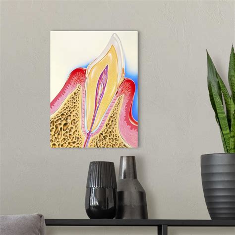 Artwork Of Tooth Showing Periodontal Disease Wall Art Canvas Prints