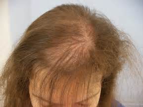Female Baldness Treatments And Remedies Medicap