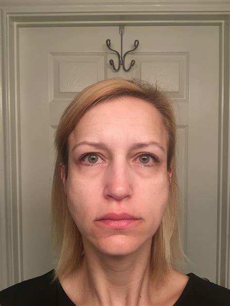 Facial Swelling Going On 3 Months With Sjogrens Sjogrens Facial