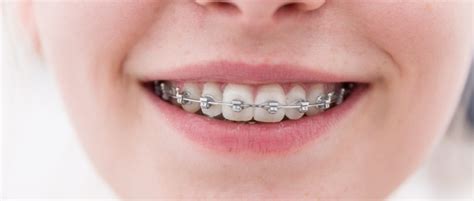Braces And Orthodontics In Coral Springs Dental Wellness Team