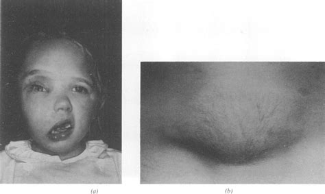 Plexiform Neurofibromas A Facial Plexiform Neurofibroma In A Four