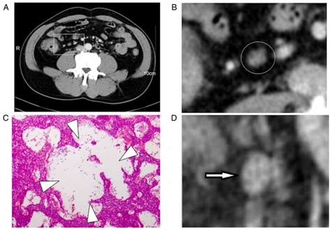 Contrast‑enhanced Ct Imaging For The Assessment Of Lymph Node Status In