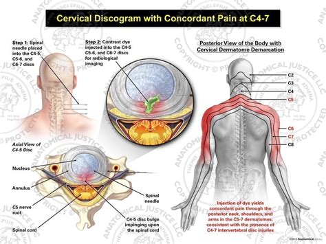 Male Central Cervical Discogram With Concordant Pain At C4 7