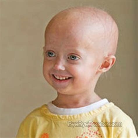 Symptoms Causes Treatment Of Disease Progeria Pictures Symptoms