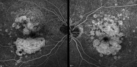 Macular Degeneration With Extensive Geographic Atrophy Retina Image Bank