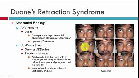 Duanes Retraction Syndrome Clinical Characteristics Youtube