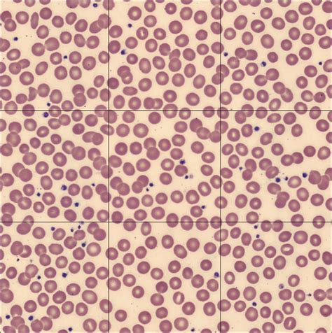 Platelet Count Calculation In Slide