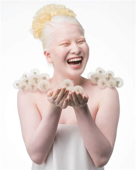 An Albino Girl Who Was Abandoned As A Baby Grows Up To Be A Vogue Model