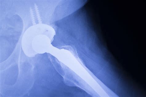 Stryker Hip Implant Recall Mcgartland Law Firm