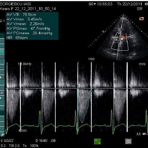 Prosthesis Patient Mismatch Assessed By Continuum Wave Doppler