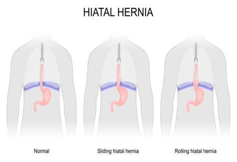 Diagnosis Hernia Hiatus Alomedika
