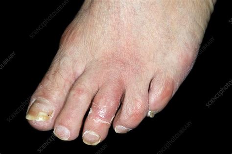 Inflamed Foot Due To Cellulitis Stock Image C0213296 Science