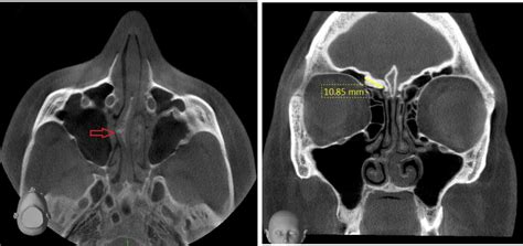 Intended for beginning radiology residents, this video highlights important structures in the temporal bone to evaluate on every temporal bone ct. CBCT Paranasal Case Studies | Cavendish Imaging