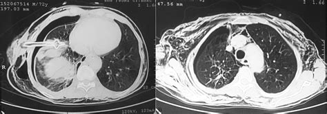 A Contrast Enhanced Ct Thorax Showing Chest Tube Lying In The Right