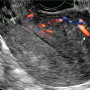 Uterine Wall Thickening Which Shows Antero Posterior Asymmetry