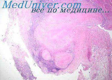 Диета для больных туберкулезом легких