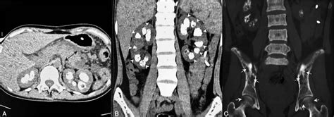 Acute Pancreatitis As An Initial Manifestation Of Parathyroi Medicine