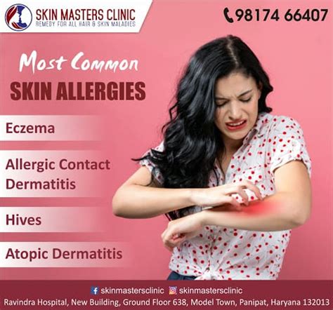 Most Common Skin Allergies Eczema Skin Masters Clinic Facebook