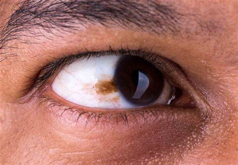 Manchas en los ojos Son peligrosas Área Oftalmológica