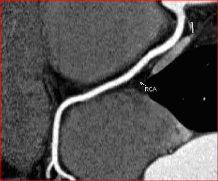 37 mri venography (mrv) brain. Coronary CT Angiography (CTA) | Radiology Associates of ...