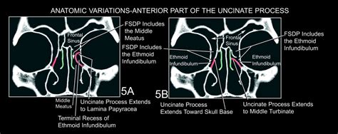 The Frontal Sinus Drainage Pathway And Related Structures American