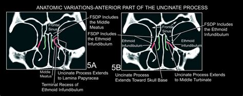 The Frontal Sinus Drainage Pathway and Related Structures | American