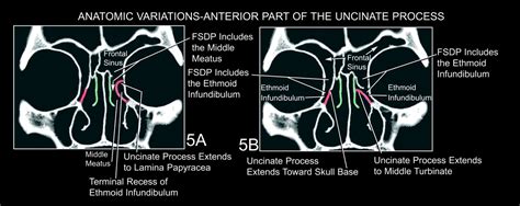 Fig 5 The Frontal Sinus Drainage Pathway And Related Structures